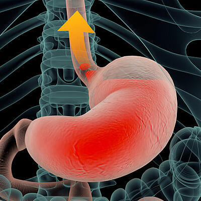 Was hilft gegen Sodbrennen?