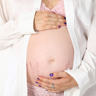 Schwangerschaftsstreifen