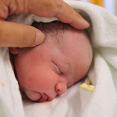 Babyakne - Neugeborenenakne